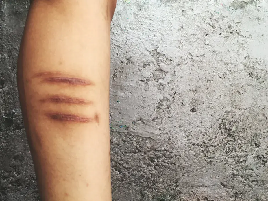 Scars on a female detainee’s legs at La Alcaidesa, Merida, that she said were the result of fights. Many women also injure themselves. Image by Ana María Arévalo. Venezuela, 2018. 