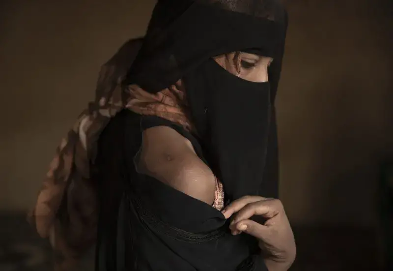 Ethiopian migrant Eman Idrees shows her shoulder, July 21, 2019, with a wound from torture after being held and abused for eight months in a desert compound, known in Arabic as a 'hosh,' run by an Ethiopian smuggler in Ras al-Ara, Lahj, Yemen. Image by AP Photo / Nariman El-Mofty. Yemen, 2019.