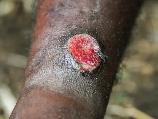Bacteria from yaws ulcers can infect another person when they enter through wounds or scratches. Image by Brian Cassey. Papua New Guinea, 2018. 